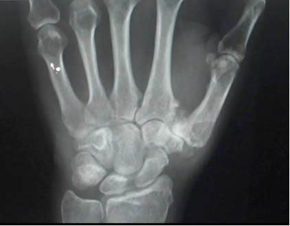 Xray of HH3’s broken wrist